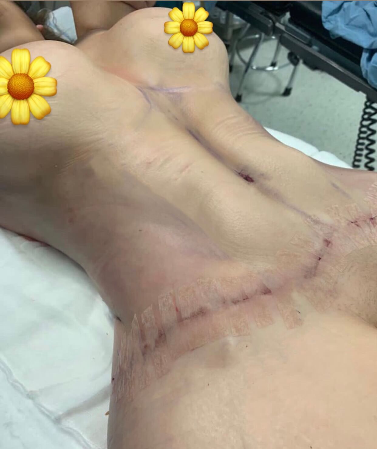 abdominoplastia despues