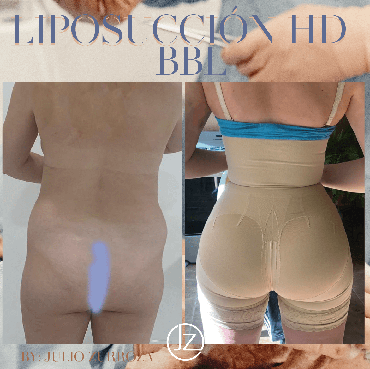 liposucción hd bbl